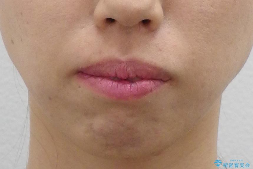 出っ歯 前歯のがたがた 口元を引っ込めたいの治療前(顔貌)