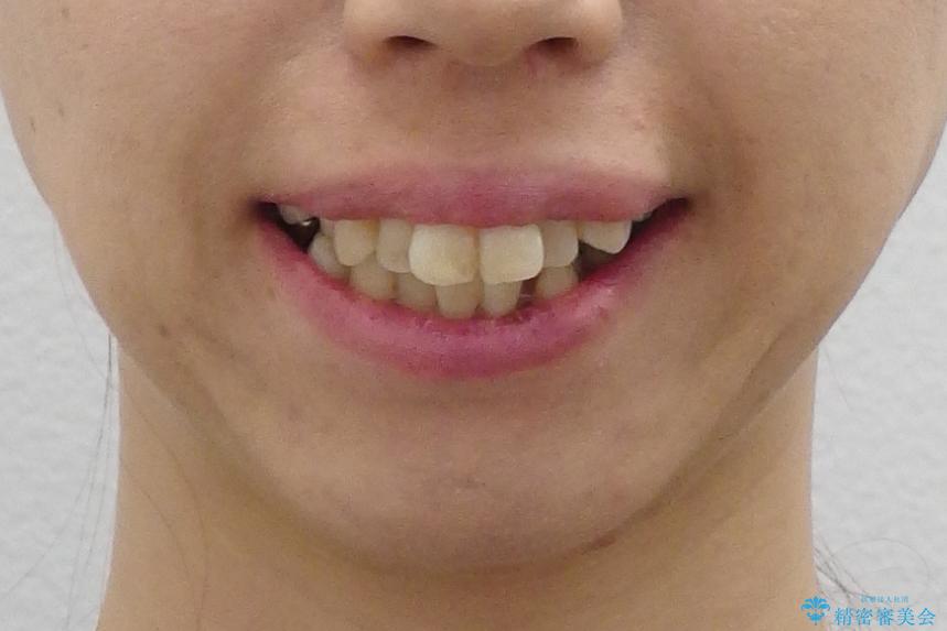 出っ歯 前歯のがたがた 口元を引っ込めたいの治療前(顔貌)