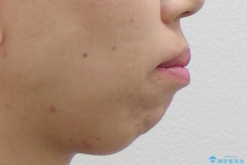 出っ歯 前歯のがたがた 口元を引っ込めたいの治療前(顔貌)