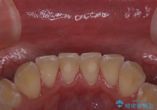 ホワイトニングせずにPMTCで明るい口元にの治療前