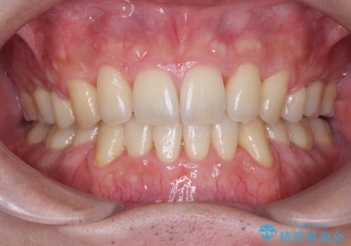 前歯のガタガタをきれいにしたい ワイヤーによる抜歯矯正で整った歯並びへの症例 治療後