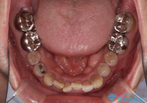 上顎の狭窄歯列 インビザラインによる拡大矯正の治療前