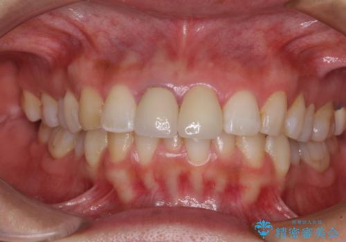 目立つ前歯の詰め物　オーダーメイドのセラミッククラウンで審美的に仕上げるの治療後