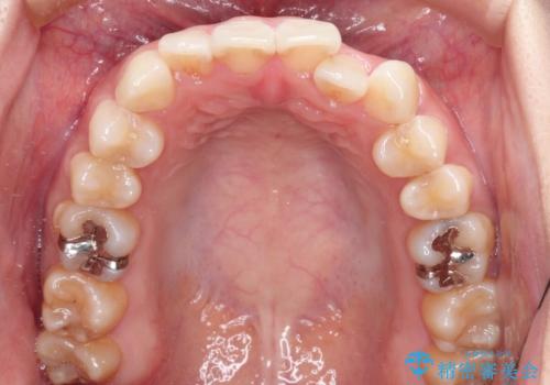 前歯のがたつきと反対咬合 インビザラインによる矯正治療の治療前