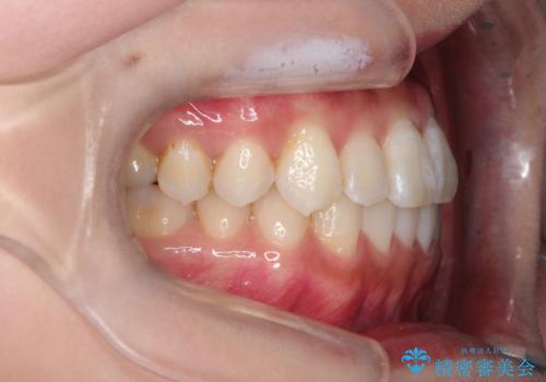 前歯のがたつきと反対咬合　インビザラインによる矯正治療の治療後