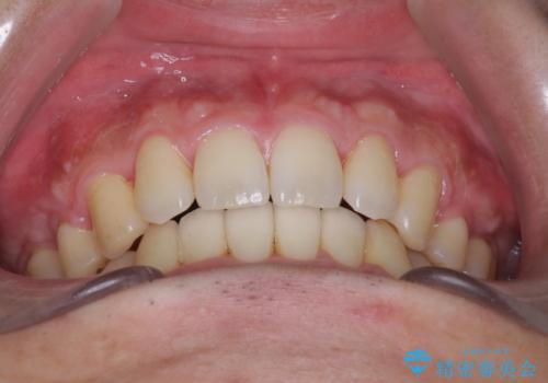 前歯のガタガタをきれいにしたい　ワイヤーによる抜歯矯正で整った歯並びへの治療後