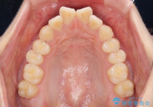 上下前歯の叢生をインビザラインできれいにの治療前
