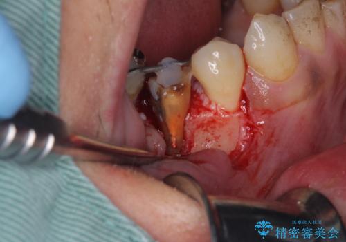 穴を開けられ抜歯となった奥歯　セラミックブリッジによる補綴治療の治療中