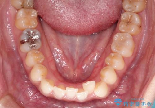 前歯のがたつきと反対咬合 インビザラインによる矯正治療の治療前