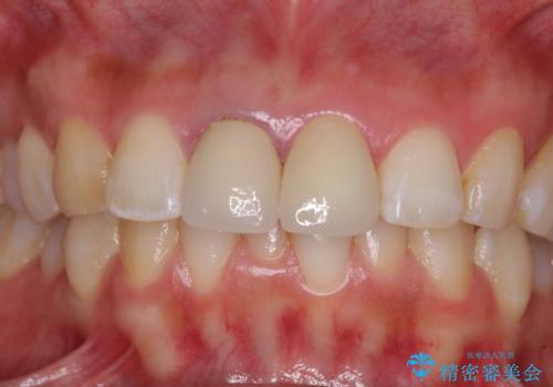 目立つ前歯の詰め物 オーダーメイドのセラミッククラウンで審美的に仕上げるの治療後