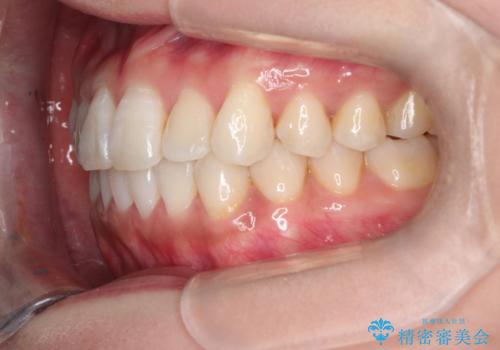 前歯のがたつきと反対咬合　インビザラインによる矯正治療の治療後