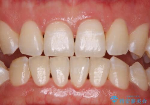 ホワイトニングせずにPMTCで明るい口元にの治療後