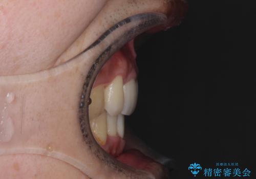 前歯のガタガタをきれいにしたい ワイヤーによる抜歯矯正で整った歯並びへの治療後