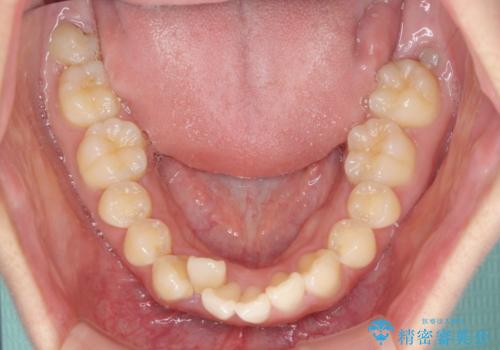 上下前歯の叢生をインビザラインできれいにの治療前