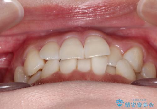 前歯のがたつきと反対咬合　インビザラインによる矯正治療の治療前