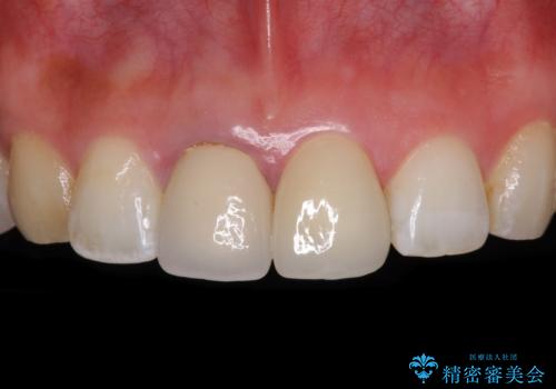 目立つ前歯の詰め物 オーダーメイドのセラミッククラウンで審美的に仕上げるの症例 治療後