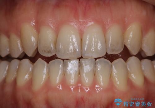 20代女性の紅茶による着色をPMTCで除去の治療前