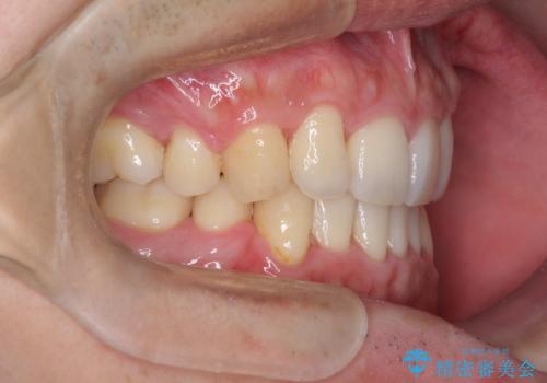 前歯のガタガタをきれいにしたい ワイヤーによる抜歯矯正で整った歯並びへの治療後