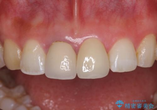 目立つ前歯の詰め物 オーダーメイドのセラミッククラウンで審美的に仕上げるの治療後