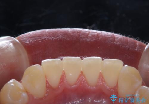 ホワイトニングせずにPMTCで明るい口元にの治療後