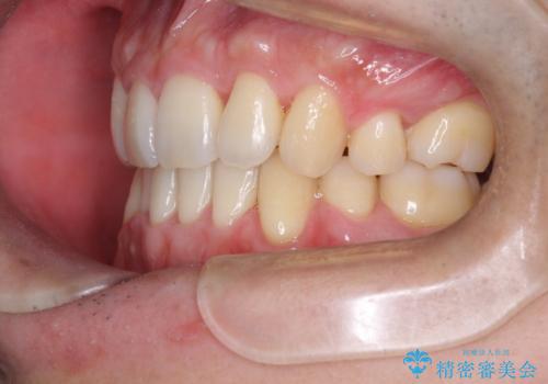 前歯のガタガタをきれいにしたい ワイヤーによる抜歯矯正で整った歯並びへの治療後