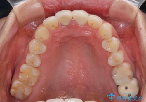 目立つ前歯の詰め物 オーダーメイドのセラミッククラウンで審美的に仕上げるの治療後