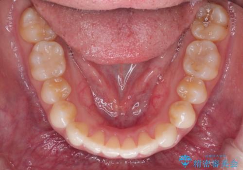 前歯のがたつきと反対咬合 インビザラインによる矯正治療の治療後