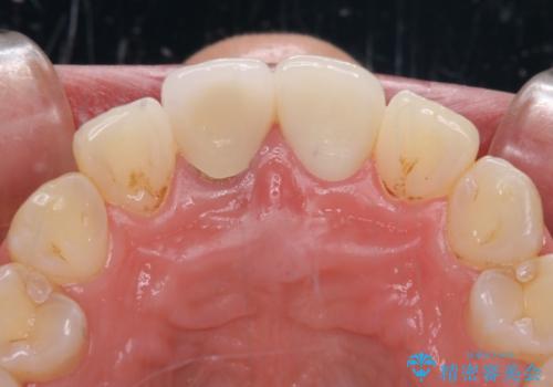 目立つ前歯の詰め物 オーダーメイドのセラミッククラウンで審美的に仕上げるの治療後
