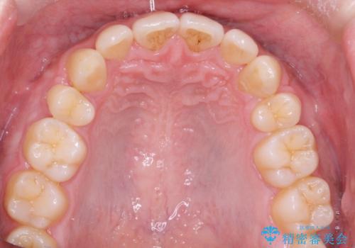 前歯のガタガタをきれいにしたい　ワイヤーによる抜歯矯正で整った歯並びへの治療後