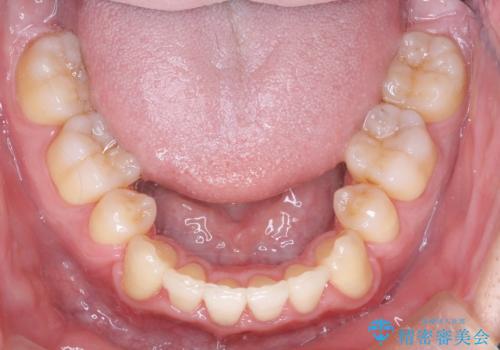 前歯のガタガタをきれいにしたい ワイヤーによる抜歯矯正で整った歯並びへの治療後