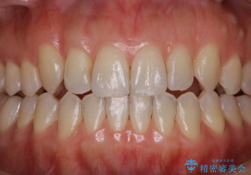 20代女性の紅茶による着色をPMTCで除去の治療後