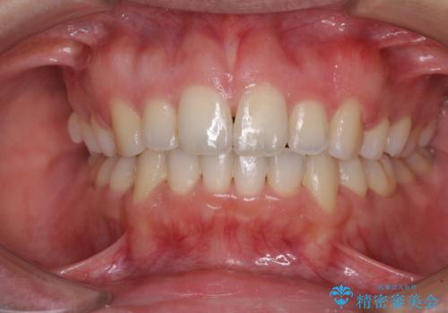 口元をスッキリと ワイヤー装置による抜歯矯正の症例 治療後