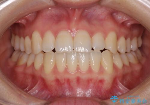 前歯のクロスバイト インビザラインによる矯正治療の治療中