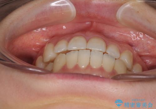 前歯のクロスバイト インビザラインによる矯正治療の治療中