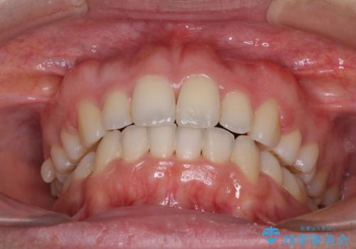 口元をスッキリと ワイヤー装置による抜歯矯正の治療後