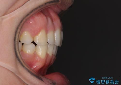 口元をスッキリと ワイヤー装置による抜歯矯正の治療後