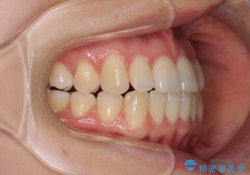 前歯のクロスバイト インビザラインによる矯正治療の治療中