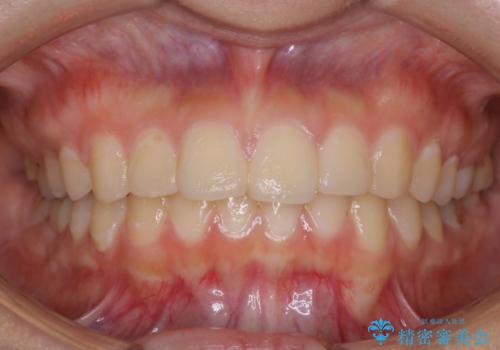 虫歯の治療が終了後にPMTCで全体を綺麗にの治療前