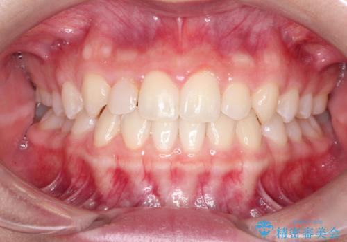 マウスピース矯正とセラミックの組み合わせ治療の治療中