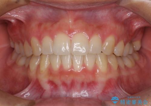 インプラントによる補綴治療とインビザライン矯正の症例 治療後