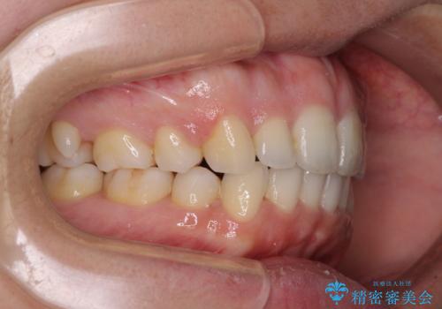口元をスッキリと　ワイヤー装置による抜歯矯正の治療後