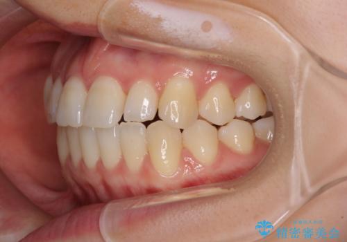 前歯のクロスバイト インビザラインによる矯正治療の治療中
