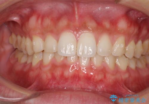 細かい隙間にものがはさまる インビザラインによる矯正治療の治療中