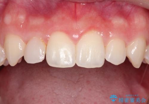 マウスピース矯正とセラミックの組み合わせ治療の治療中