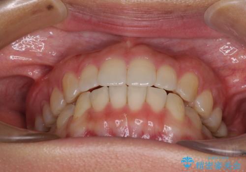 インプラントによる補綴治療とインビザライン矯正の治療後