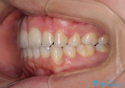 口元をスッキリと ワイヤー装置による抜歯矯正の治療後