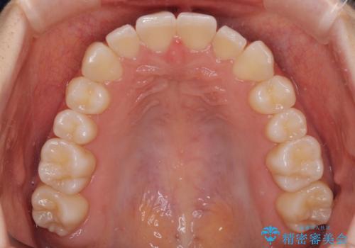 前歯のクロスバイト インビザラインによる矯正治療の治療中