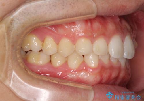 細かい隙間にものがはさまる インビザラインによる矯正治療の治療中