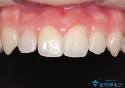 マウスピース矯正とセラミックの組み合わせ治療の治療中