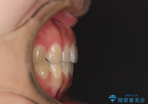 インプラントによる補綴治療とインビザライン矯正の治療後